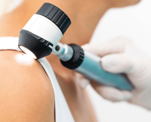 Doctor observando la piel del hombro de una paciente en caso de cáncer de piel